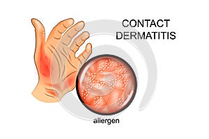 Allergen on the skin. Allergy, dermatology