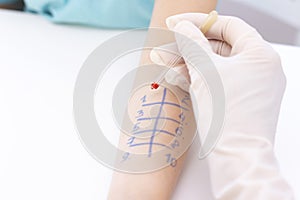 Allergen test on hand. child undergoing procedure of allergen skin test