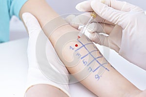 Allergen test on hand. child undergoing procedure of allergen skin test