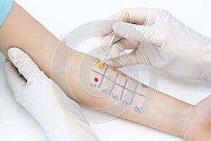 Allergen test on hand. child undergoing procedure of allergen skin test