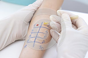 Allergen test on hand. procedure of allergen skin test