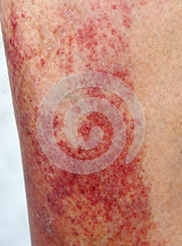 Allergic contact dermatitis at shin
