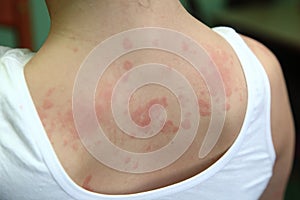 Allergic dermatitis photo