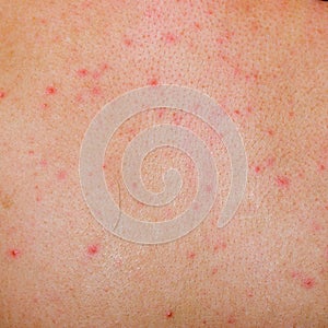 Allergic rash dermatitis skin