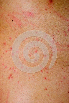 Allergic rash dermatitis skin photo