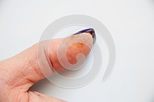 Allergic reaction and rash on the finger, skin irritation, dry skin