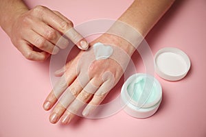 Allergic reaction on skin of hands. Red rash and hand care cream photo