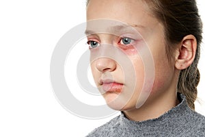 Allergic reaction, skin rash, close view portrait of a girl`s face. Redness and inflammation of the skin in the eyes and lips.