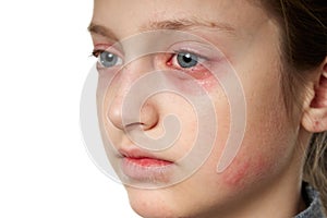 Allergic reaction, skin rash, close view portrait of a girl`s face. Redness and inflammation of the skin in the eyes and lips. photo