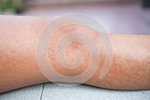 Allergic reactions caused by urticaria