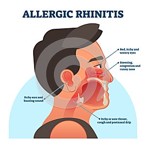 Allergic rhinitis medical diagram, vector illustration labeled information photo