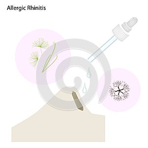 The Allergic Rhinitis Patient with Nose Drops