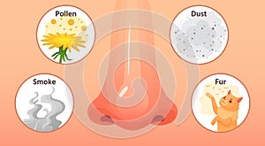Allergic sickness. Red nose, allergy illnesses symptoms and allergens. Smoke, pollen and dust allergies cartoon vector photo