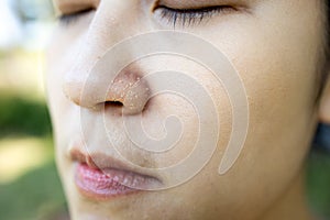 Allergic young woman have eczema dry nose on winter season,female people peeling skin with seborrheic dermatitis,atopic symptom on photo
