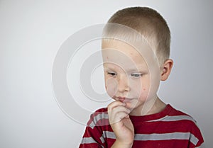 An allergist or dermatologist examines red spots on a childâ€™s face. The boy suffers from a rash, hives and itching. Food Allergy