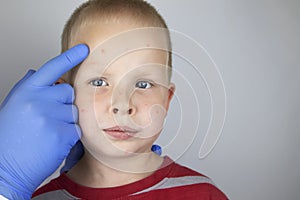 An allergist or dermatologist examines red spots on a childâ€™s face. The boy suffers from a rash, hives and itching. Food Allergy