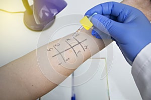 An allergist doctor in the laboratory conducts a prik allergy test. Skin test for household, food, epidermal allergic reactions