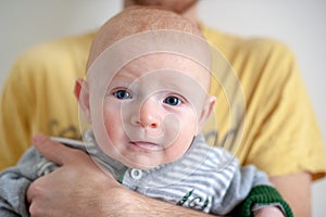 Allergy on the baby`s head