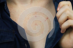 Allergy concept. Young woman with pimples on the chest, closeup