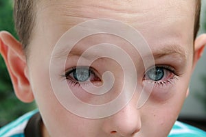 Allergy and conjunctivitis photo