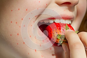 Allergy food strawberry and abstract allergic reaction on the girl's face photo