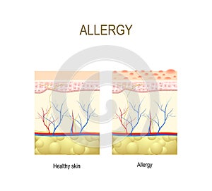 Allergy. healthy and skin with allergic reaction.