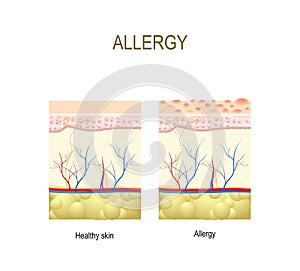 Allergy. healthy and skin with allergic reaction. photo