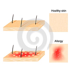 Allergy. healthy skin and allergic reactions.