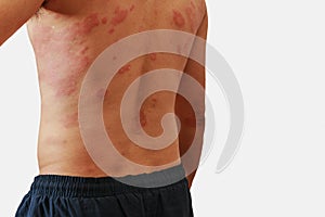 Allergy rash and Health problem.