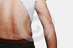 Allergy rash and Health problem.
