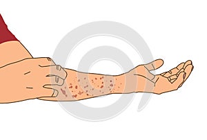 Allergy rash red on arm, itching from urticaria or atopic dermatitis, illustration on white background