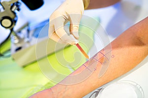 Allergy - skin tests