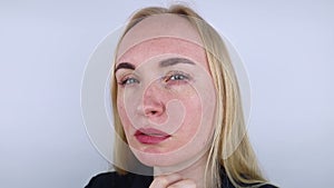 Allergy to cosmetics. The girl looks at the pimples around her eyes that appeared after using toxic cosmetics. Red spots on woman