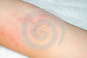 Allergy to red rash on the arms photo