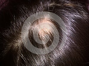 Alopecia aerata caused by dramatic or tragic events