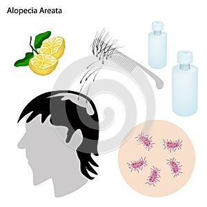 Alopecia Areata with Disease Prevention and Treatment
