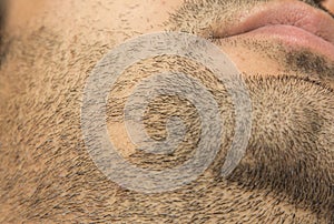 Alopecia Areata hair loss on cheek beard in a patch