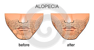 Alopecia areata on the male chin