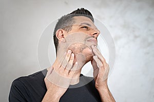 Alopecia areata on a man`s beard