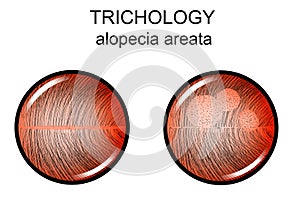 Alopecia areata. trichology