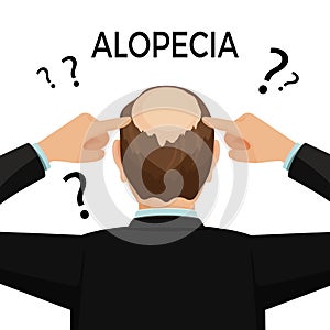 Alopecia concept. Man is showing his hairloss nape.