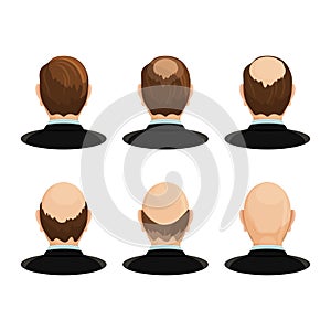 Alopecia concept. Set of heads showing the hairloss progress.