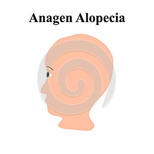 Alopecia hair. Baldness of hair on the head. Anagen Alopecia. Infographics. Vector illustration on isolated background. photo
