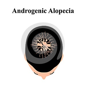 Alopecia hair. Baldness of hair on the head. Androgenic alopecia. Infographics. Vector illustration on isolated