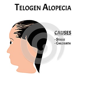 Alopecia hair. Baldness of hair on the head. Telogen Alopecia causes. Infographics. Vector illustration on isolated