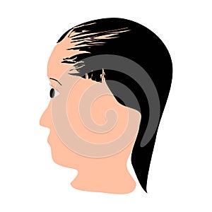 Alopecia hair. Baldness of hair on the head. Telogen Alopecia. Infographics. Vector illustration on isolated background.