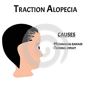 Alopecia hair. Baldness of hair on the head. Traction alopecia causes. Infographics. Vector illustration on isolated