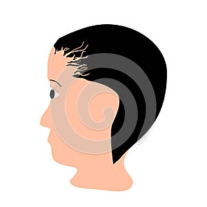 Alopecia hair. Baldness of hair on the head. Traction alopecia. Infographics. Vector illustration on isolated background
