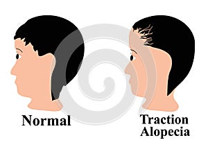 Alopecia hair. Baldness of hair on the head. Traction alopecia. Infographics. Vector illustration on isolated background