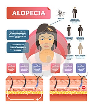 Alopecia - hair loss autoimmune disease medical vector diagram illustration
